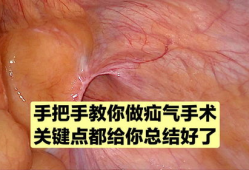 疝气手术视频,从术前准备到术后恢复