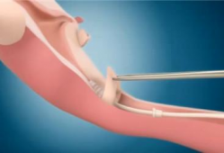 上环手术视频,专业视角下的操作步骤与注意事项