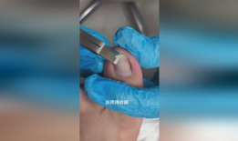 甲沟炎视频,视频解析病因、症状及治疗全攻略